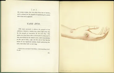 Image: An Inquiry into the Causes and Effects of the Variolae Vaccinae (facsimile)