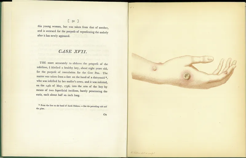 An Inquiry into the Causes and Effects of the Variolae Vaccinae (facsimile)