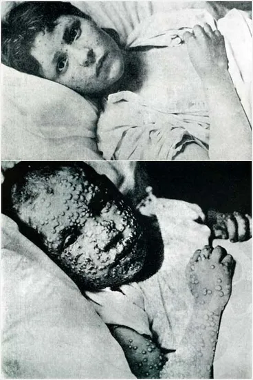 Image: Smallpox